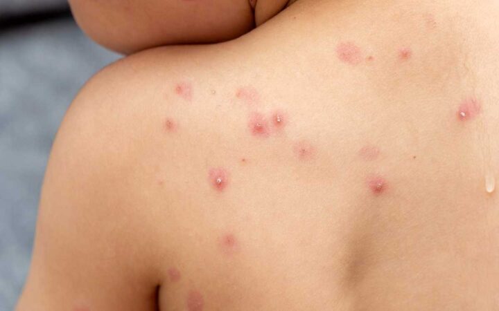 OMS declara nuevamente el mpox como una emergencia internacional de salud pública OMS declara nuevamente el mpox como una emergencia internacional de salud pública