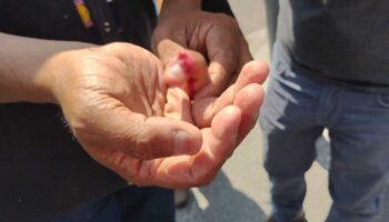 Amputan dedo a manifestante lesionado por seguridad del Congreso de Morelos