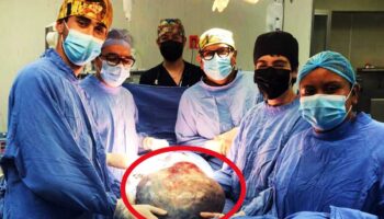 Retiran tumor gigante de 21 kilos a derechohabiente del IMSS