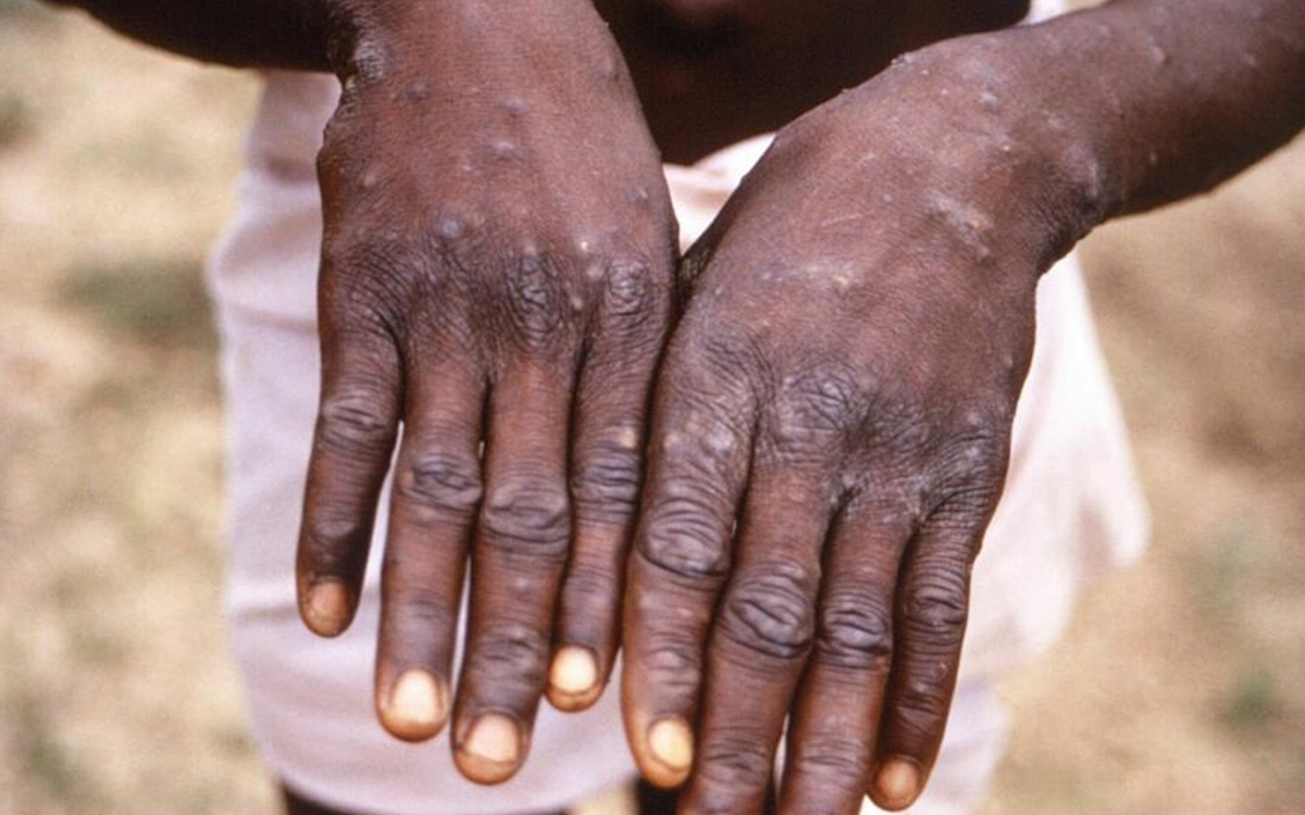 Will the monkeypox epidemic return to Africa?