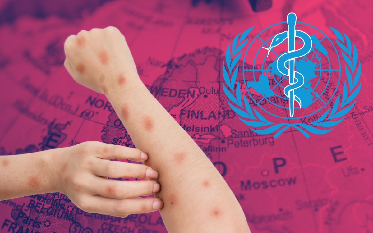 Mpox | WHO recommends that masks be worn only by doctors and caregivers