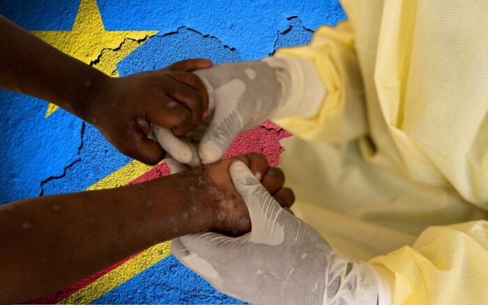 mpox DRC, International Health Emergency