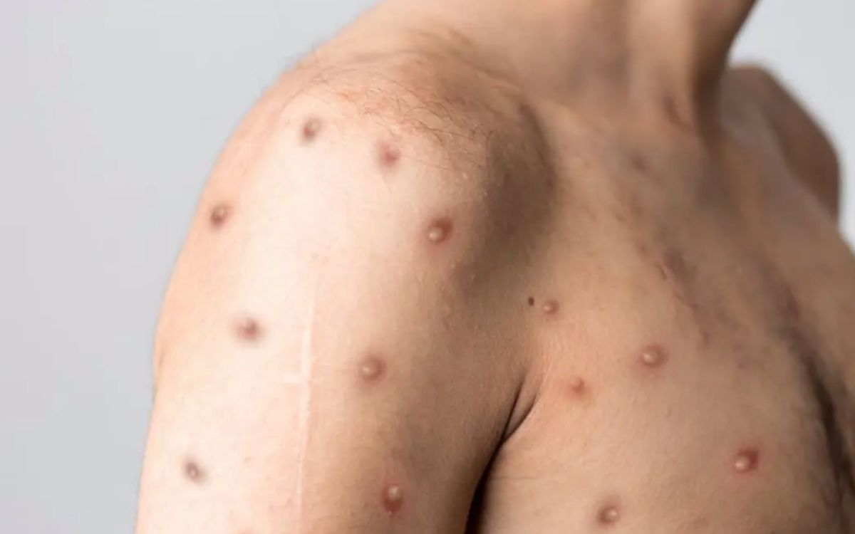 These countries have reported cases of monkeypox, which has been declared a global emergency