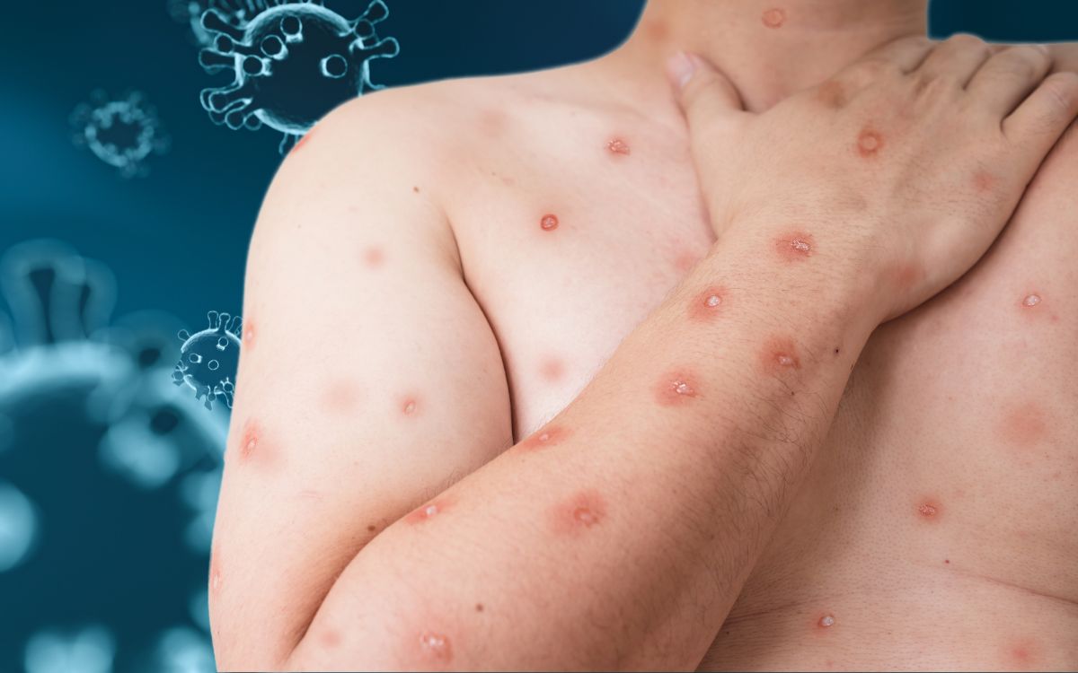 Smallpox cases in Europe have increased by 50% in the past month