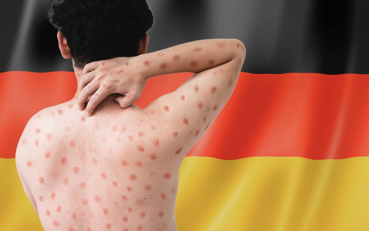 Germany confirms its first case of infection with the new mpox variant