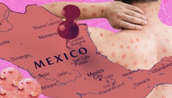Alertan por caso de mpox en México; festival de Zipolite, posible punto de infección