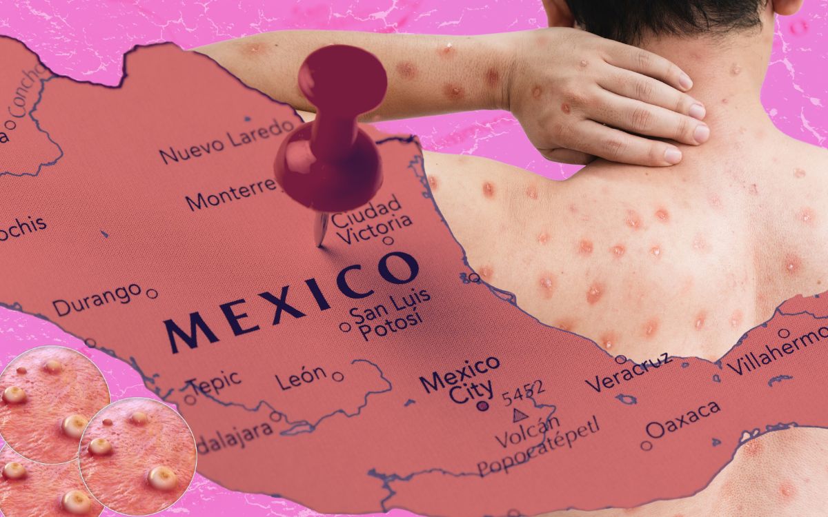 mpox salud mexico