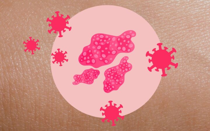 Herpes Zóster: ¿Cuál es el mejor método para prevenirlo? Herpes Zóster: ¿Cuál es el mejor método para prevenirlo?