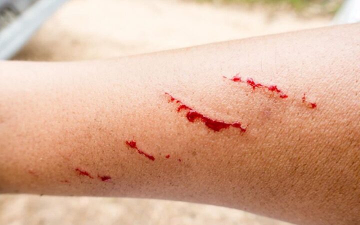 Zacatecas | Adolescente recibe atención por posible rabia tras mordida de zorrillo Zacatecas | Adolescente recibe atención por posible rabia tras mordida de zorrillo